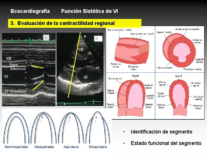 Ecocardiografía Función Sistólica de VI 3. Evaluación de la contractilidad regional Anterobasal PP Posterobasal Ecocardiografía Función Sistólica de VI 3. Evaluación de la contractilidad regional Anterobasal PP Posterobasal