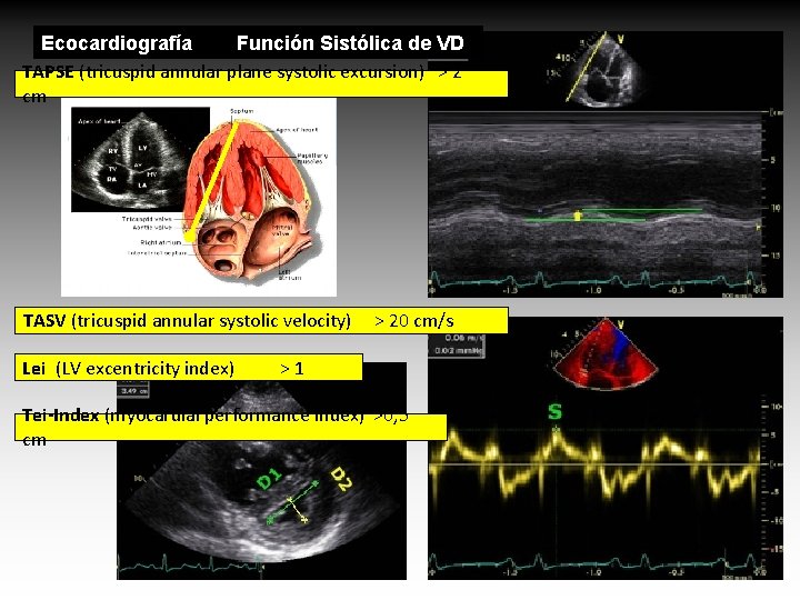 Ecocardiografía Función Sistólica de VD TAPSE (tricuspid annular plane systolic excursion) > 2 cm Ecocardiografía Función Sistólica de VD TAPSE (tricuspid annular plane systolic excursion) > 2 cm