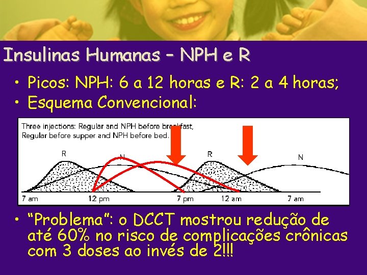 Insulinas Humanas – NPH e R • Picos: NPH: 6 a 12 horas e