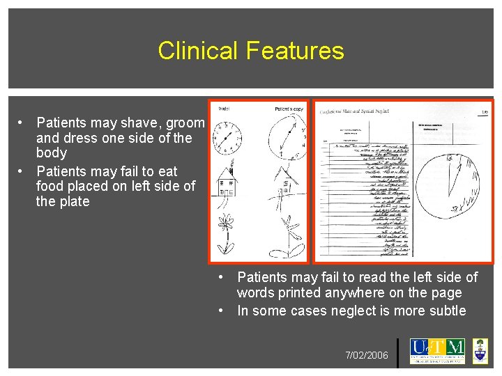 Clinical Features • Patients may shave, groom and dress one side of the body