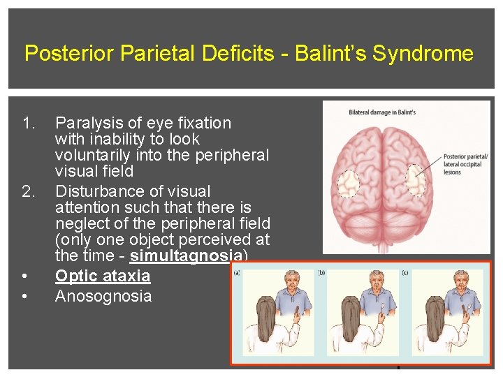 Posterior Parietal Deficits - Balint’s Syndrome 1. 2. • • Paralysis of eye fixation
