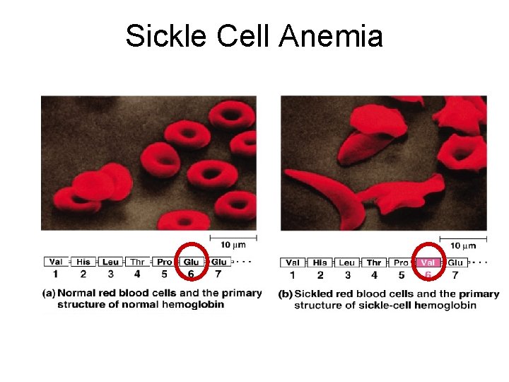 Sickle Cell Anemia 