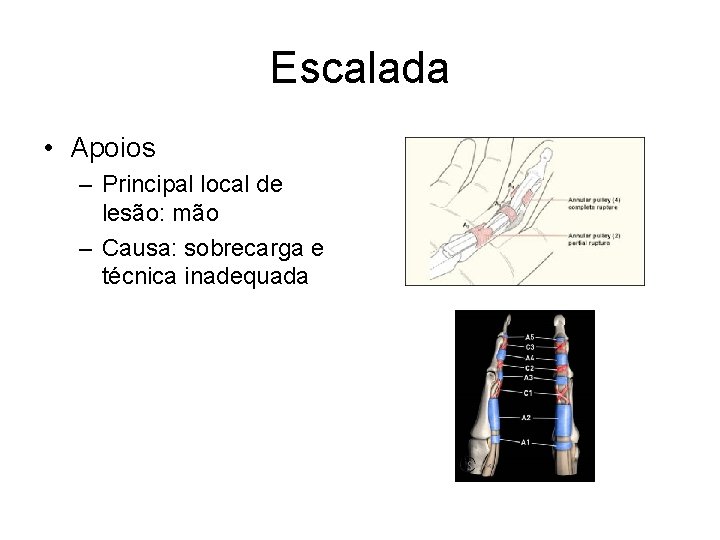 Escalada • Apoios – Principal local de lesão: mão – Causa: sobrecarga e técnica