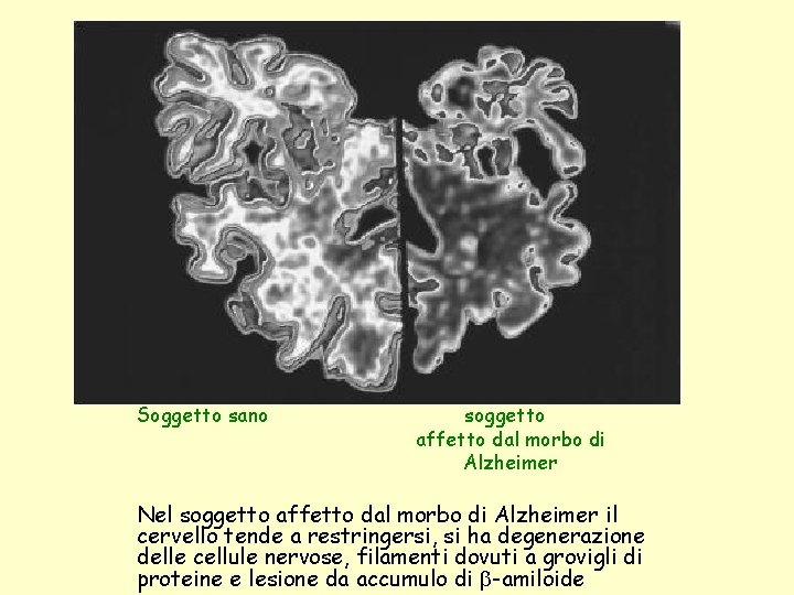 Soggetto sano soggetto affetto dal morbo di Alzheimer Nel soggetto affetto dal morbo di