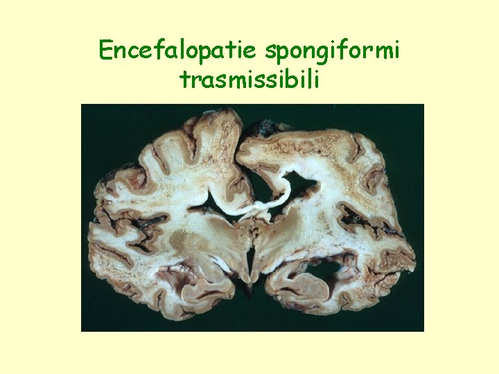 Encefalopatie spongiformi trasmissibili 