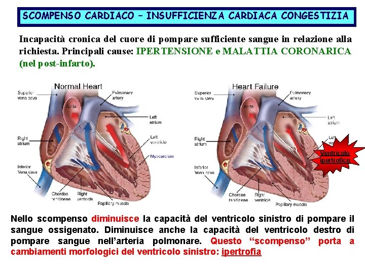 SCOMPENSO CARDIACO – INSUFFICIENZA CARDIACA CONGESTIZIA Incapacità cronica del cuore di pompare sufficiente sangue