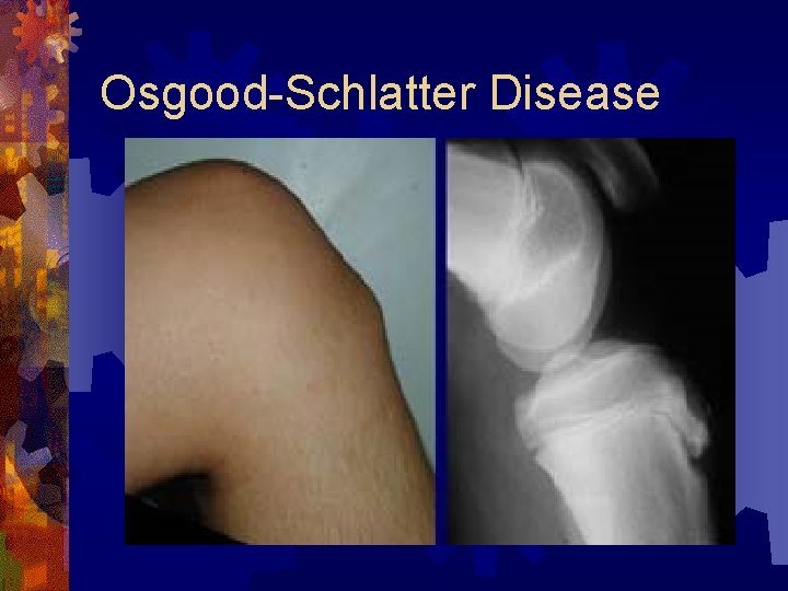 Osgood-Schlatter Disease 