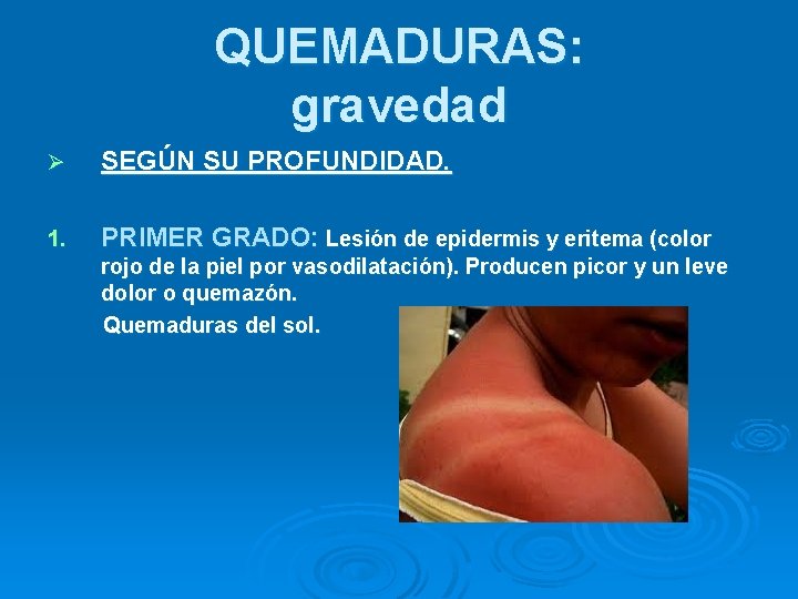 QUEMADURAS: gravedad Ø SEGÚN SU PROFUNDIDAD. 1. PRIMER GRADO: Lesión de epidermis y eritema