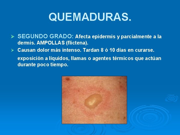 QUEMADURAS. Ø SEGUNDO GRADO: Afecta epidermis y parcialmente a la dermis. AMPOLLAS (flictena). Ø