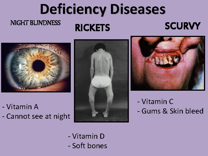 Deficiency Diseases NIGHT BLINDNESS RICKETS - Vitamin A - Cannot see at night -