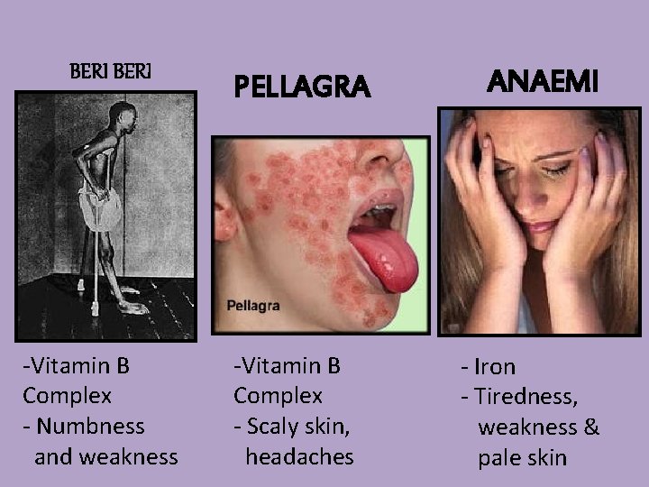 BERI -Vitamin B Complex - Numbness and weakness PELLAGRA -Vitamin B Complex - Scaly