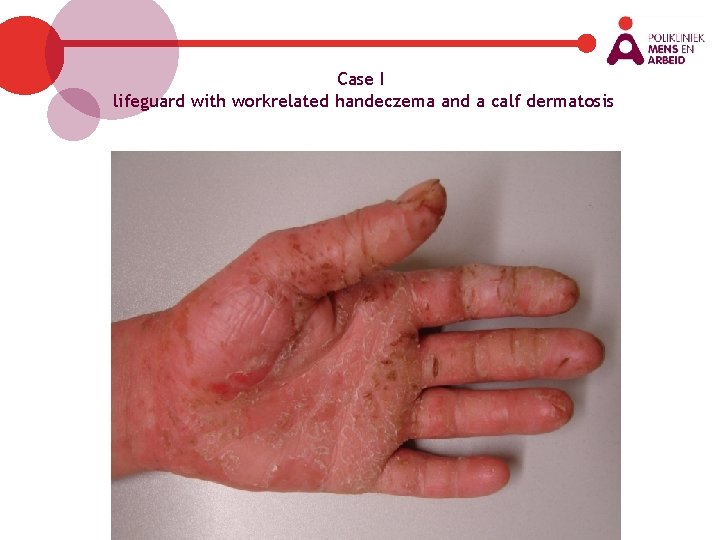 Case I lifeguard with workrelated handeczema and a calf dermatosis 