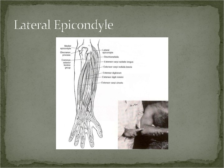 Lateral Epicondyle 