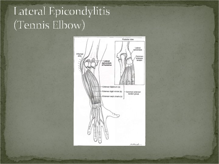Lateral Epicondylitis (Tennis Elbow) 