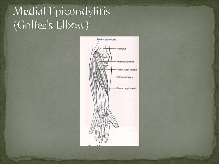 Medial Epicondylitis (Golfer’s Elbow) 