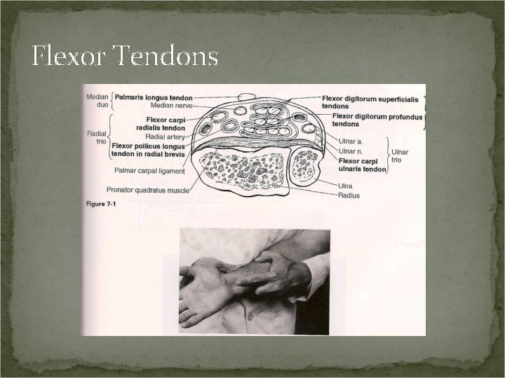 Flexor Tendons 