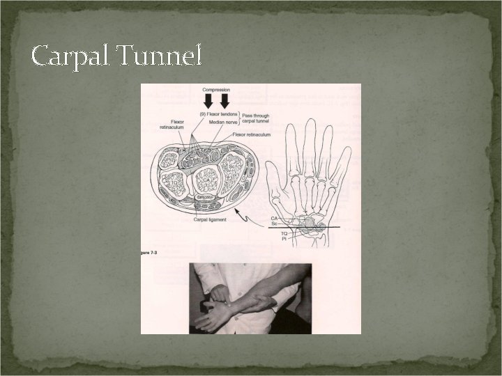 Carpal Tunnel 