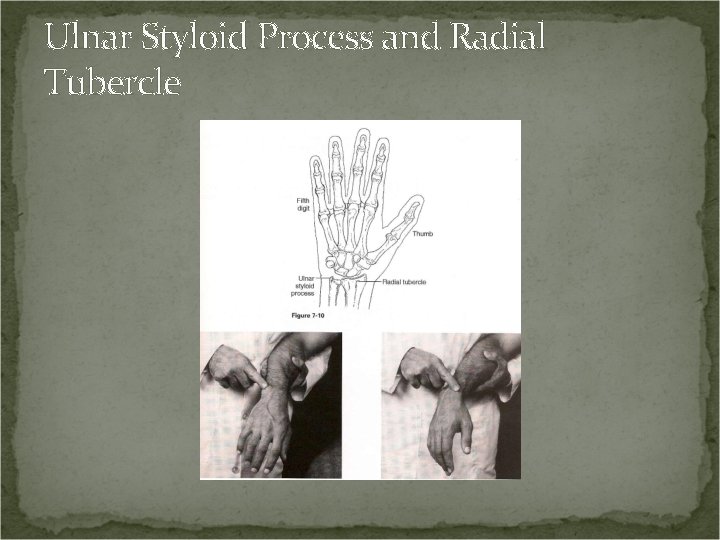 Ulnar Styloid Process and Radial Tubercle 