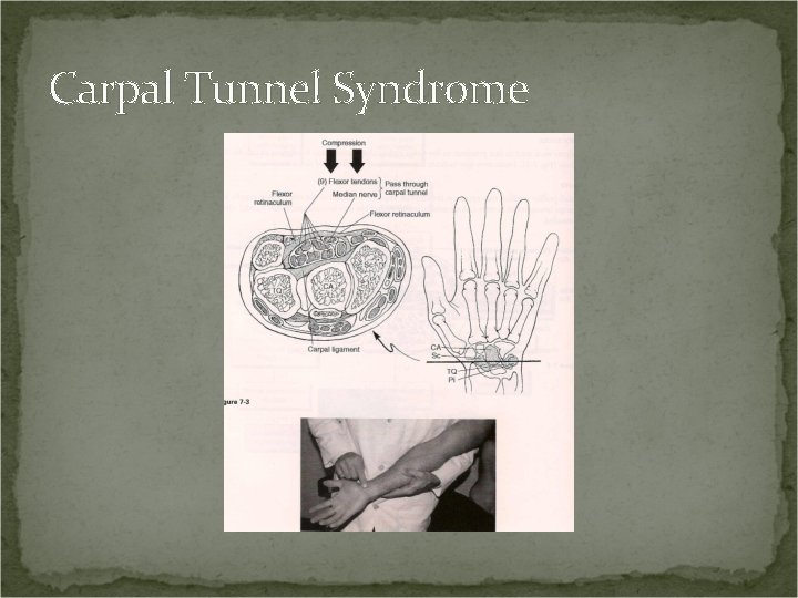 Carpal Tunnel Syndrome 