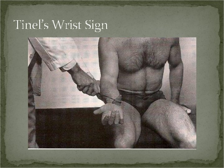 Tinel’s Wrist Sign 