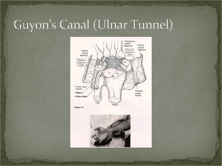 Guyon’s Canal (Ulnar Tunnel) 