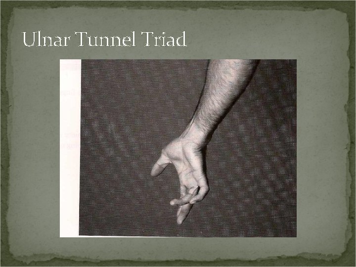 Ulnar Tunnel Triad 
