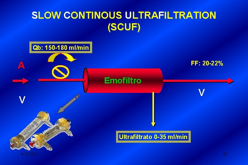SLOW CONTINOUS ULTRAFILTRATION (SCUF) Qb: 150 -180 ml/min FF: 20 -22% A Emofiltro V