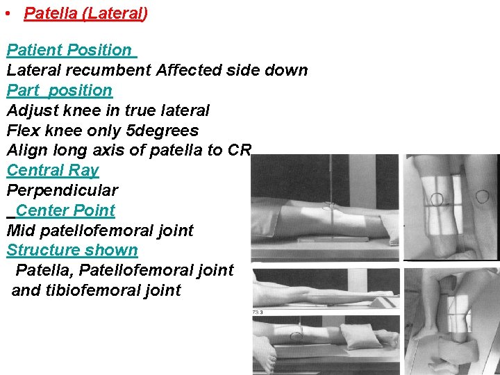 • Patella (Lateral) Patient Position Lateral recumbent Affected side down Part position Adjust