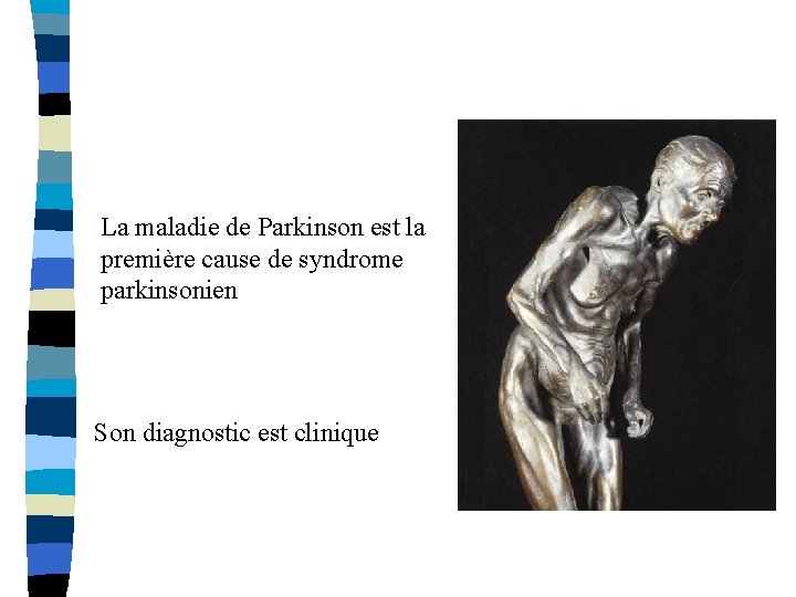 La maladie de Parkinson est la première cause de syndrome parkinsonien Son diagnostic est