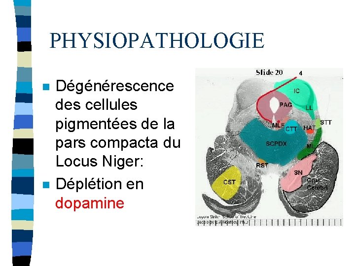 PHYSIOPATHOLOGIE n n Dégénérescence des cellules pigmentées de la pars compacta du Locus Niger:
