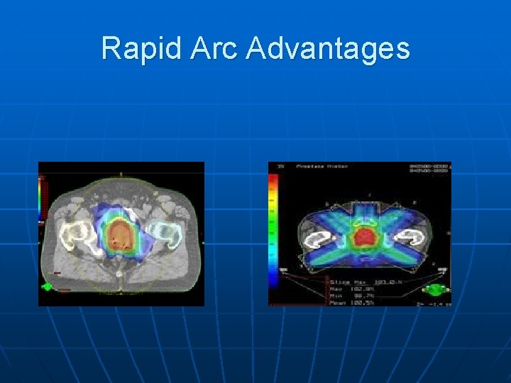 Rapid Arc Advantages 