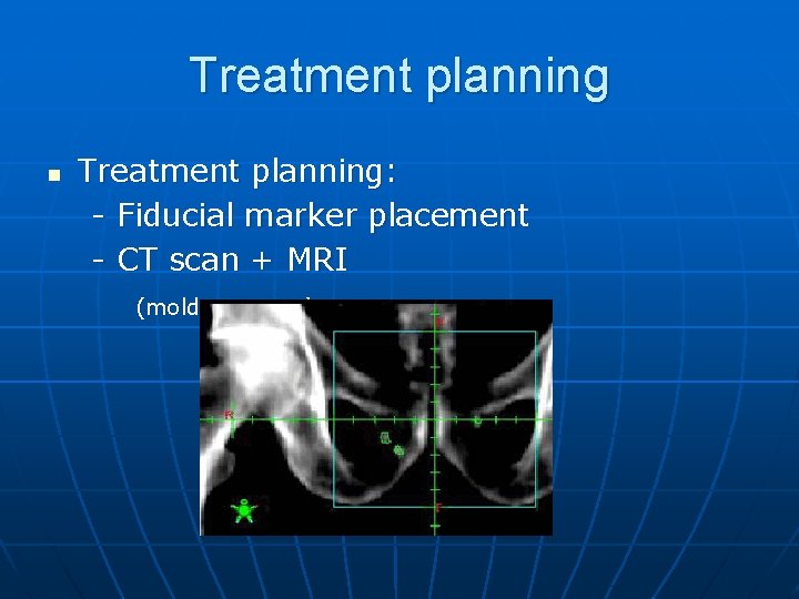 Treatment planning n Treatment planning: - Fiducial marker placement - CT scan + MRI