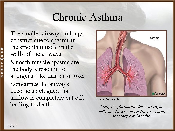 Chronic Asthma The smaller airways in lungs constrict due to spasms in the smooth