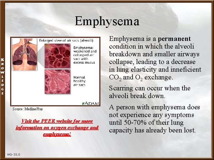 Emphysema is a permanent condition in which the alveoli breakdown and smaller airways collapse,