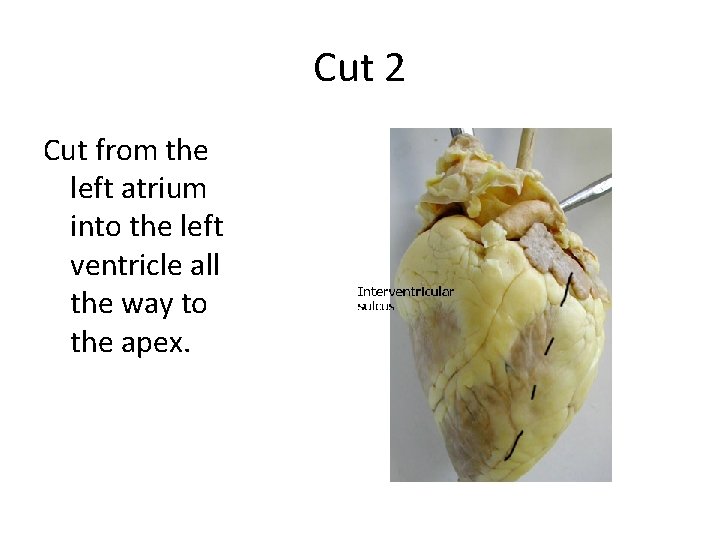 Cut 2 Cut from the left atrium into the left ventricle all the way