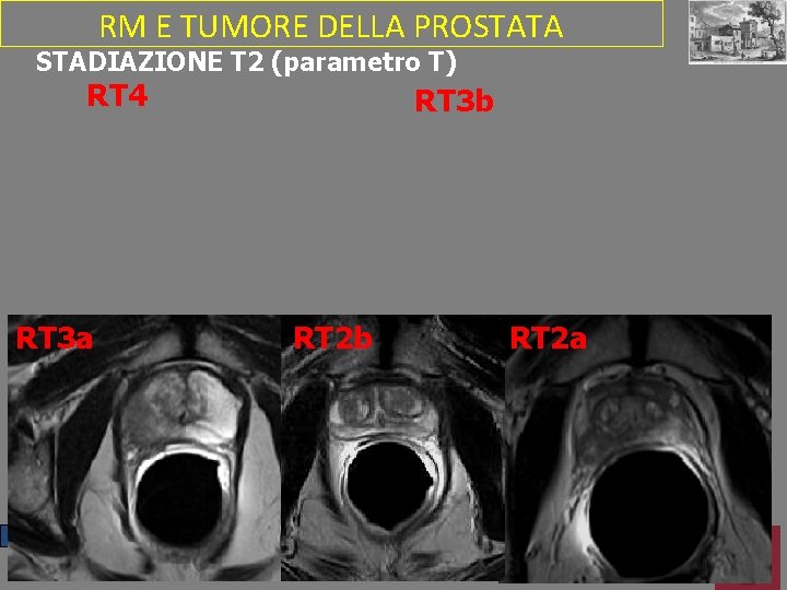 RM E TUMORE DELLA PROSTATA STADIAZIONE T 2 (parametro T) RT 4 RT 3