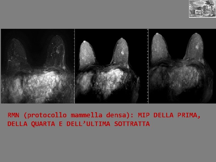 RMN (protocollo mammella densa): MIP DELLA PRIMA, DELLA QUARTA E DELL’ULTIMA SOTTRATTA 