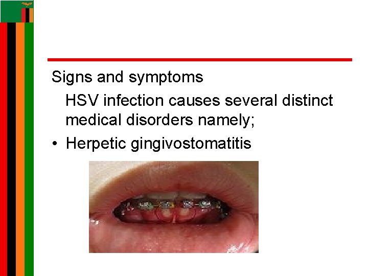 Signs and symptoms HSV infection causes several distinct medical disorders namely; • Herpetic gingivostomatitis Signs and symptoms HSV infection causes several distinct medical disorders namely; • Herpetic gingivostomatitis