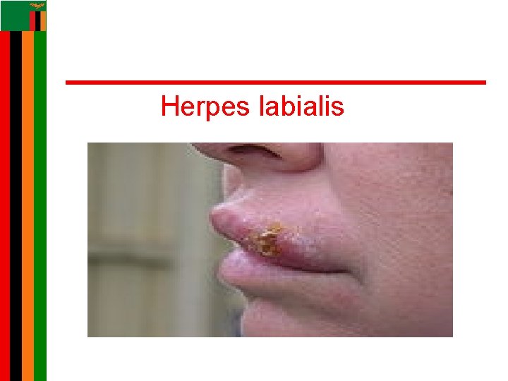 Herpes labialis Herpes labialis
