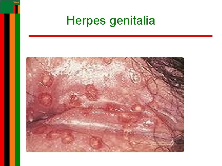 Herpes genitalia Herpes genitalia