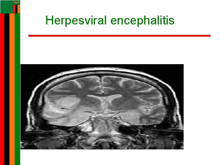 Herpesviral encephalitis Herpesviral encephalitis