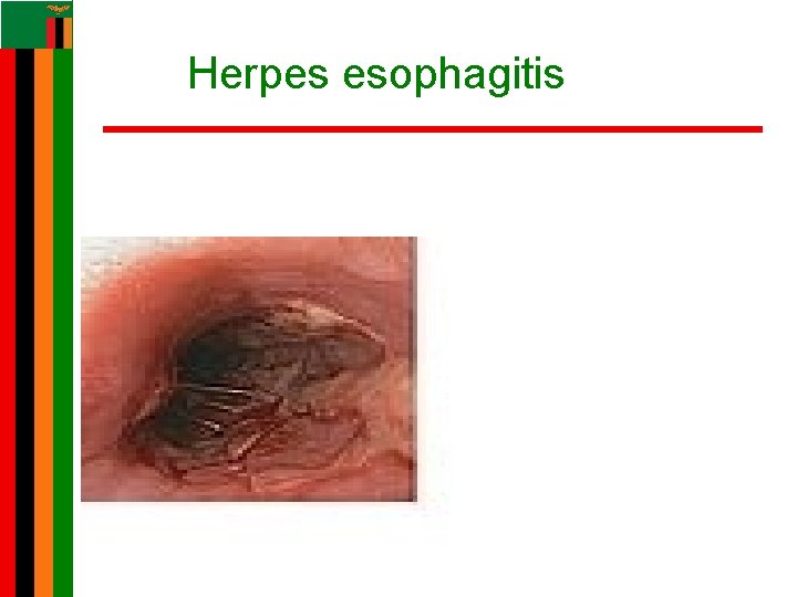 Herpes esophagitis Herpes esophagitis