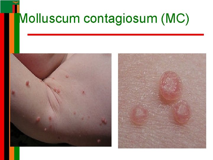 Molluscum contagiosum (MC) Molluscum contagiosum (MC)