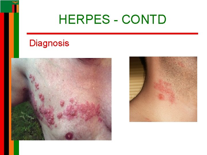 HERPES - CONTD Diagnosis HERPES - CONTD Diagnosis