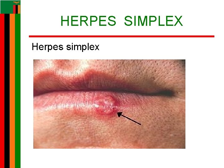 HERPES SIMPLEX Herpes simplex HERPES SIMPLEX Herpes simplex