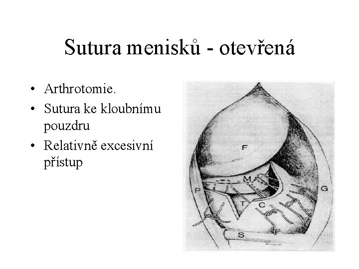Sutura menisků - otevřená • Arthrotomie. • Sutura ke kloubnímu pouzdru • Relativně excesivní