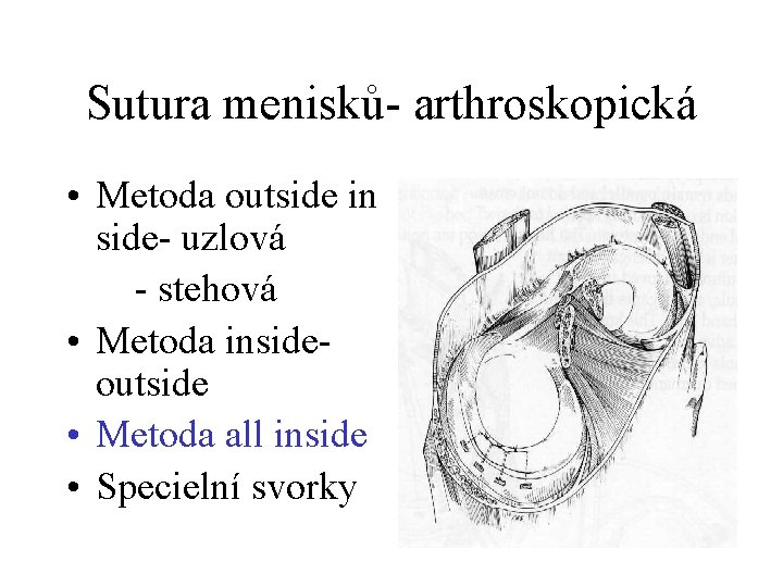 Sutura menisků- arthroskopická • Metoda outside in side- uzlová - stehová • Metoda insideoutside