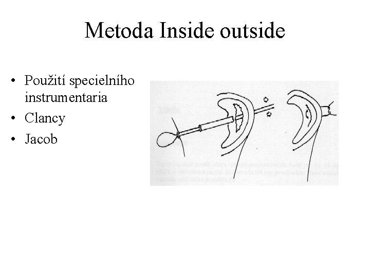 Metoda Inside outside • Použití specielního instrumentaria • Clancy • Jacob 