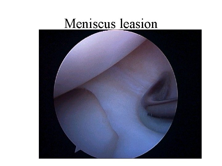 Meniscus leasion 