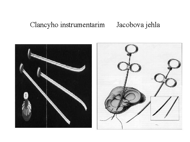 Clancyho instrumentarim Jacobova jehla 